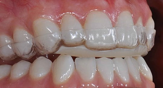 Bite terapia per il trattamento del bruxismo e dei disordini temporo mandibolari