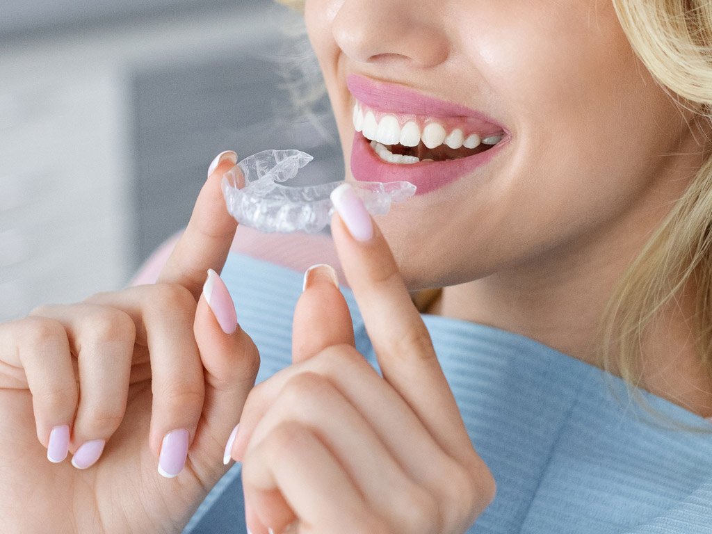 Allineatori trasparenti utilizzati come applicazione clinica in odontoiatria estetica