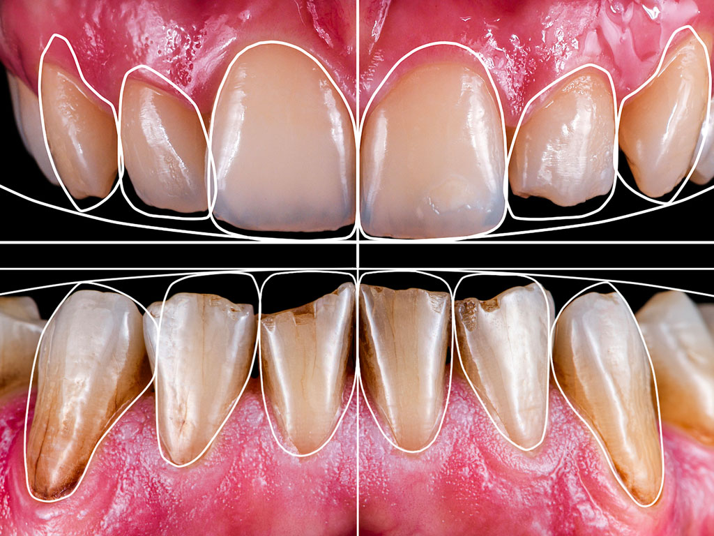 Faccette dentali progettate digitalmente secondo protocolli di odontoiatria estetica