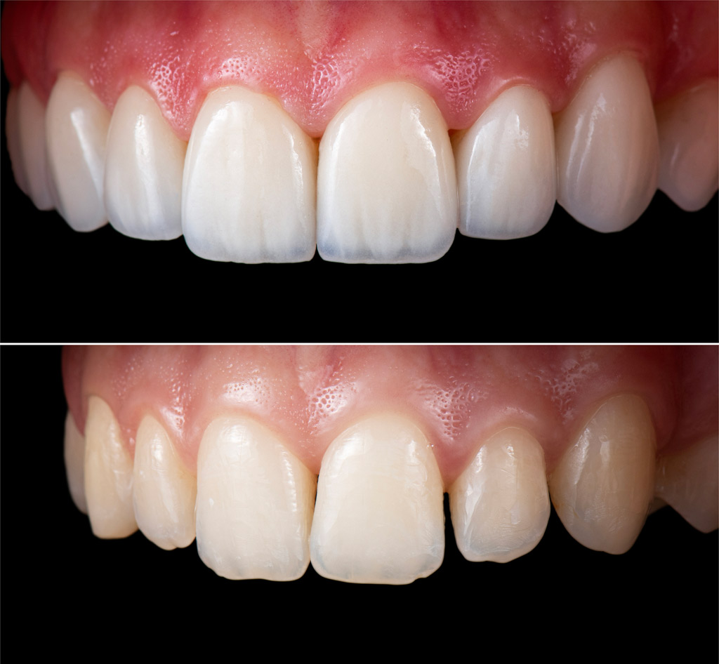 Faccette dentali per il miglioramento estetico del sorriso