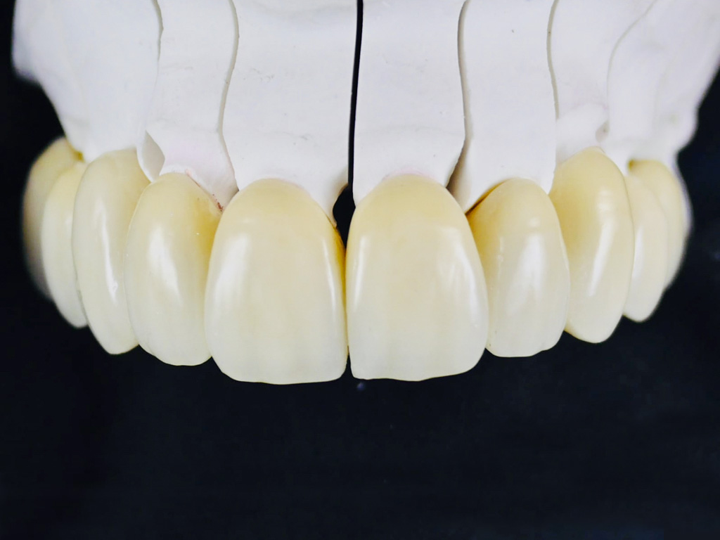 Arcate dentali complete per la riabilitazione protesica fissa