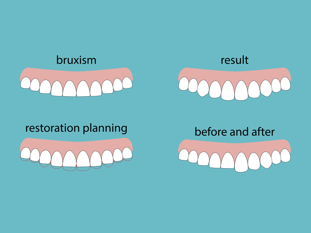 Bruxismo: serramento dentale e usura dei denti