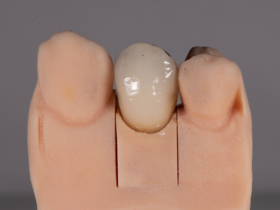 Corone dentali per il ripristino estetico e funzionale dei denti