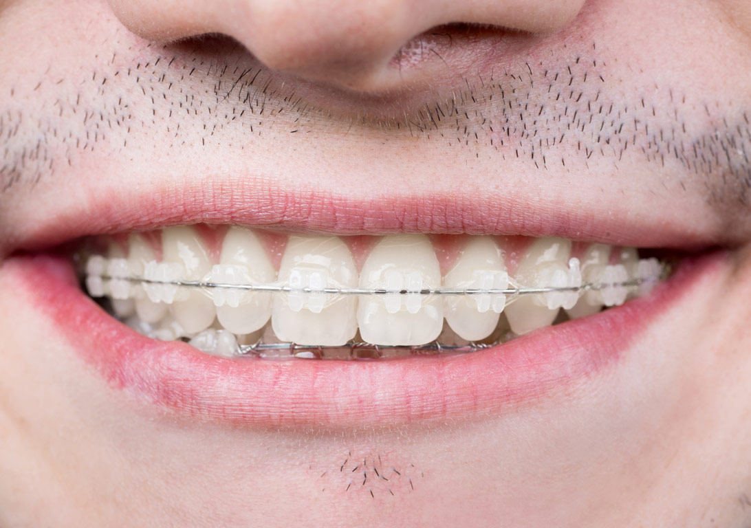 Trattamenti di ortodonzia per adulti orientati a estetica e funzionalità