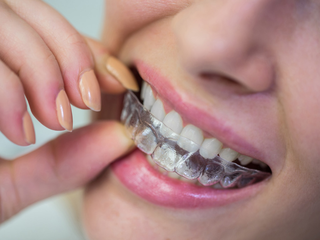 Allineatori trasparenti come soluzione di ortodonzia invisibile per adulti