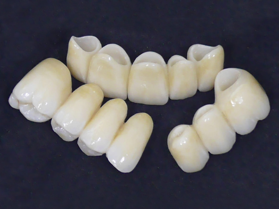 Ponti dentali per la sostituzione di denti mancanti nella protesi fissa