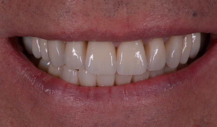 Denti fissi con implantologia a carico immediato Implantologia a carico immediato con denti fissi a Olbia