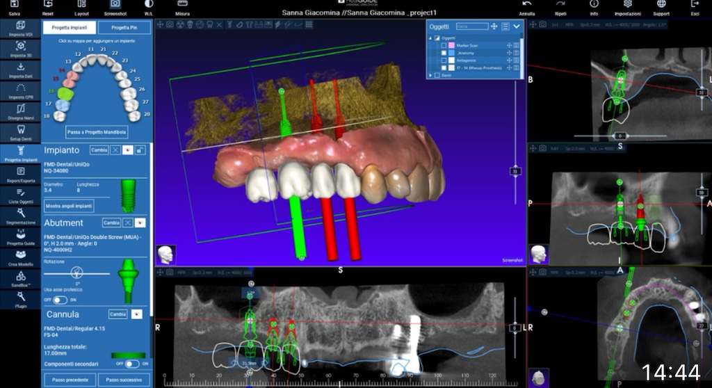 Implantologia computer guidata – pianificazione digitale Implantologia computer guidata con pianificazione digitale 3D a Olbia